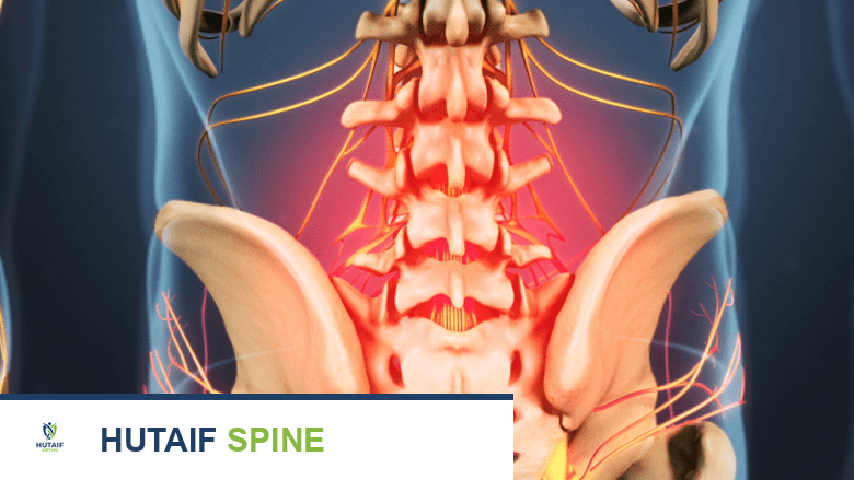 الانقسام الفقاري (Spondylolysis) والانزلاق الفقاري البرزخي: الأعراض، التشخيص، وخيارات العلاج المتقدمة في صنعاء مع الأستاذ الدكتور محمد هطيف