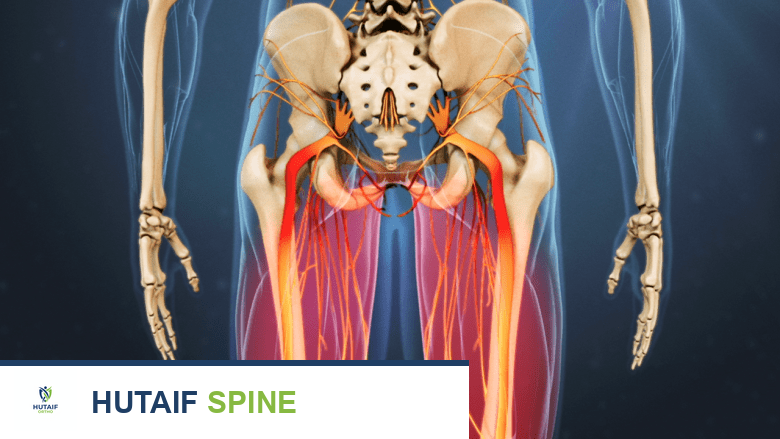 تضيق القناة الشوكية المركزية الأعراض الأسباب والخيارات العلاجية مع الأستاذ الدكتور محمد هطيف
