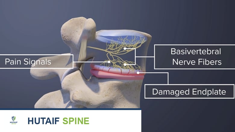 أعراض آلام الظهر الفقرية: دليلك الشامل للتشخيص والعلاج مع الأستاذ الدكتور محمد هطيف
