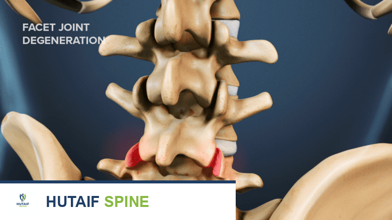 الكيس الزليلي في العمود الفقري القطني: دليل شامل للمرضى مع الأستاذ الدكتور محمد هطيف