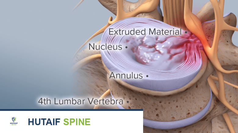 صورة توضيحية لبروز المادة الداخلية للقرص الفقري في الجزء L3-L4