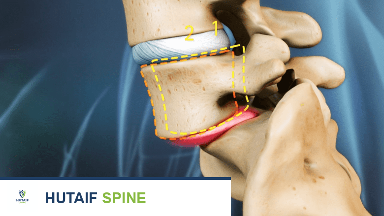 توضيح يظهر الانزلاق الفقاري الإسثمي