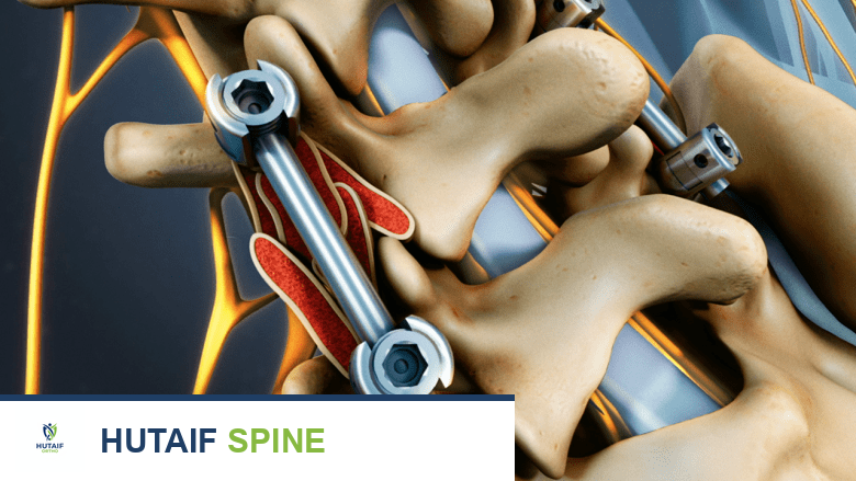 توضيح يظهر براغي البيديكل والقضبان في جراحة الدمج