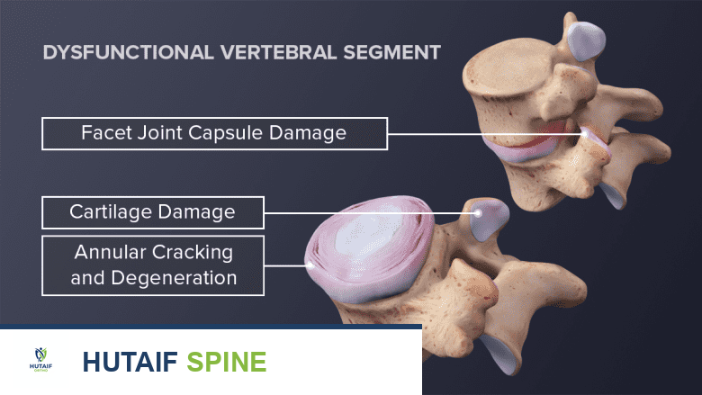 أسباب الانزلاق الغضروفي الصدري: دليل شامل للتشخيص والعلاج من الأستاذ الدكتور محمد هطيف في صنعاء