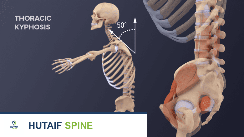 الحداب الصدري: تقوس الظهر العلوي للأمام - الأسباب، الأعراض، والعلاج مع الأستاذ الدكتور محمد هطيف