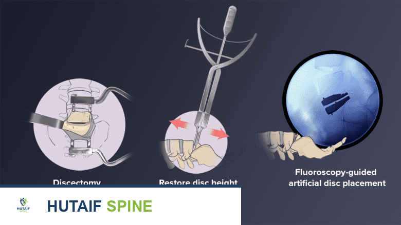 استبدال القرص الكلي للعمود الفقري القطني: حل متقدم لآلام الظهر المزمنة واستعادة الحركة مع الأستاذ الدكتور محمد هطيف