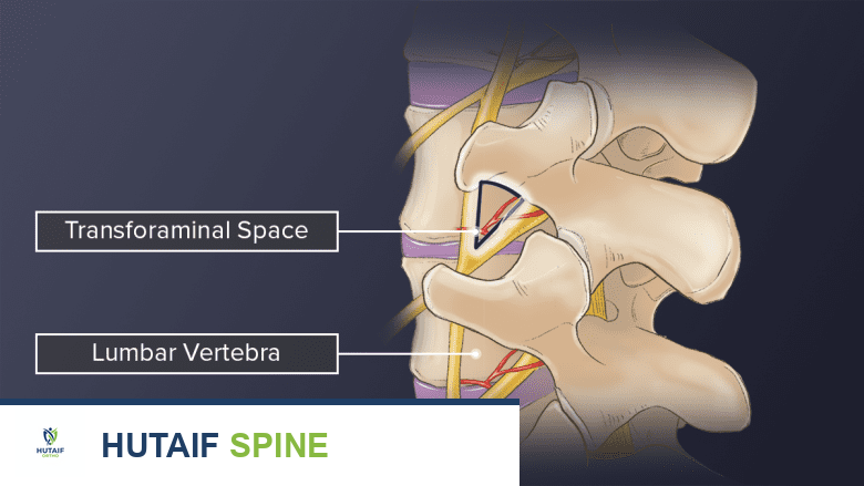 عملية دمج الفقرات القطنية عبر الثقب (TLIF): حل فعال لآلام الظهر المزمنة مع الأستاذ الدكتور محمد هطيف