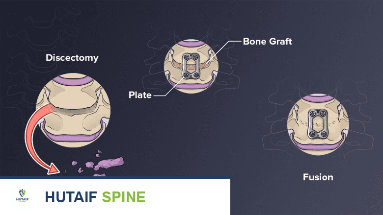 علاج آلام الرقبة الناتجة عن التهاب الفقار اللاصق: دليل شامل للمرضى