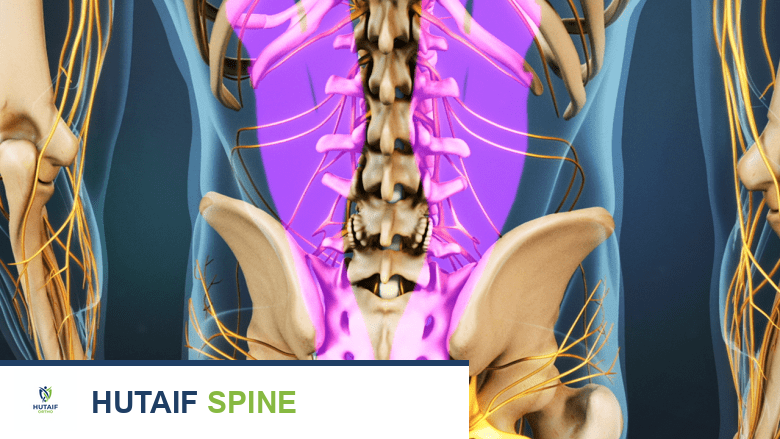 رسم توضيحي يظهر جراحة استئصال الصفيحة الفقرية القطنية.