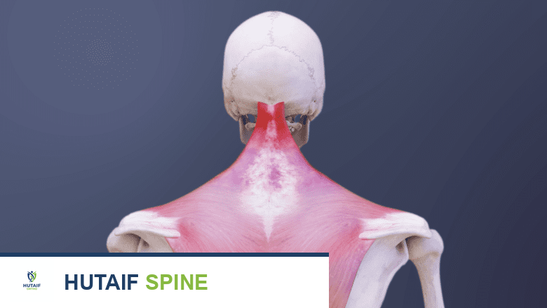 صورة ثلاثية الأبعاد لعضلات الرقبة المتضررة توضح نقاط الزناد كعقد مؤلمة