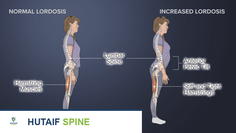 آلام الظهر أثناء الحمل: دليل شامل للأنواع، الأسباب، والعلاج مع الأستاذ الدكتور محمد هطيف