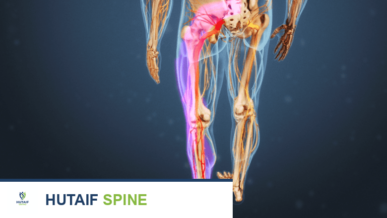 ألم عرق النسا: الأنواع، الأسباب، الأعراض الشاملة والعلاج الفعال في صنعاء مع الدكتور هطيف