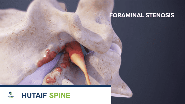 أنواع تضيق العمود الفقري: دليلك الشامل مع الأستاذ الدكتور محمد هطيف