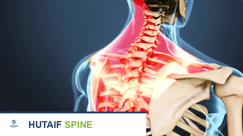 أعراض كسور الفقرات: دليل شامل من الأستاذ الدكتور محمد هطيف في صنعاء