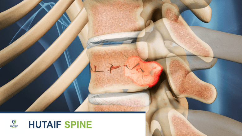مخاطر ومضاعفات عملية رأب الفقرات (Vertebroplasty): دليلك الشامل