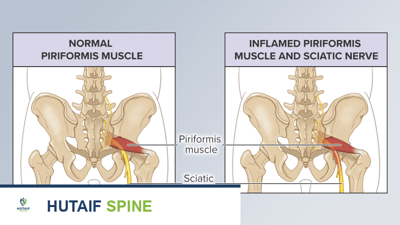 توضيح يظهر عضلة الكمثرى الطبيعية مقابل الملتهبة.