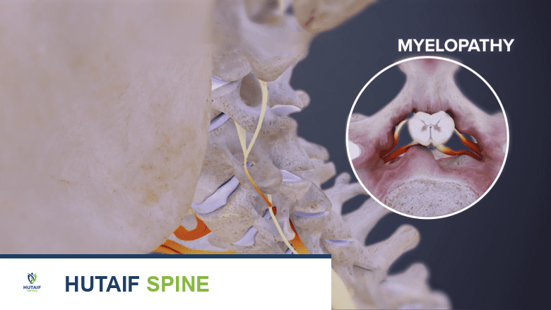 متلازمة كليبل فيل: دليل شامل لفهم الحالة وإدارتها مع الأستاذ الدكتور محمد هطيف