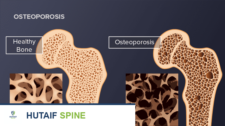 هشاشة العظام كل ما تحتاج لمعرفته الأسباب الأعراض التشخيص والعلاج والوقاية