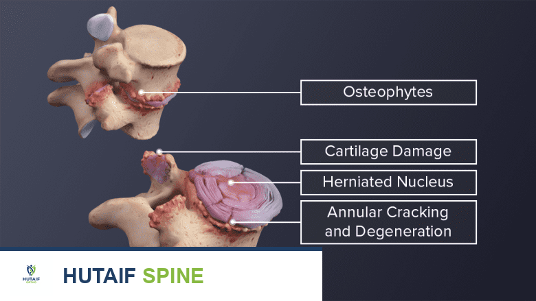 توضيح لتدهور الفقرات والأقراص في العمود الفقري