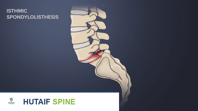 دعامة الظهر: متى تحتاجها وكيف تساعد في تخفيف آلام العمود الفقري؟ دليل شامل من الأستاذ الدكتور محمد هطيف