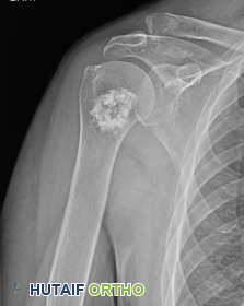 ورم الغضروف الخبيث (Chondrosarcoma): دليل شامل للمرضى مع الأستاذ الدكتور محمد هطيف