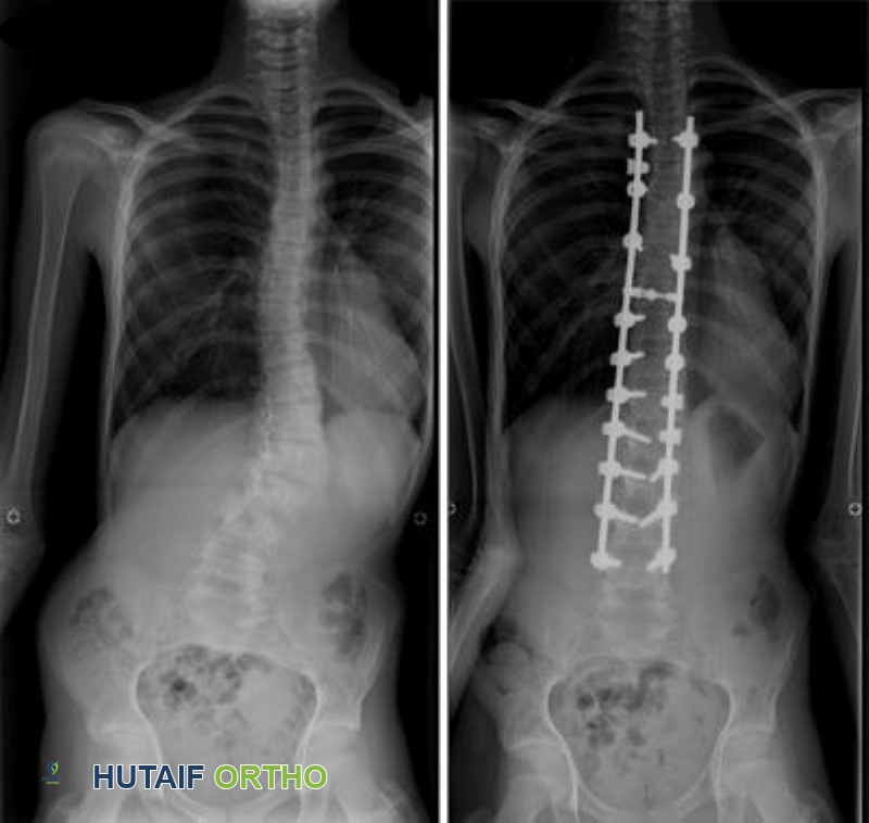 صور بالأشعة السينية قبل وبعد جراحة الجنف