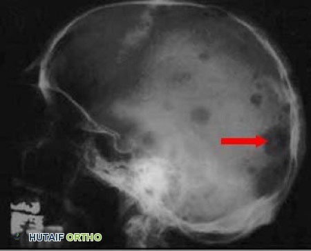 الورم النقوي المتعدد والبلازماوي: دليل شامل للمرضى مع الأستاذ الدكتور محمد هطيف