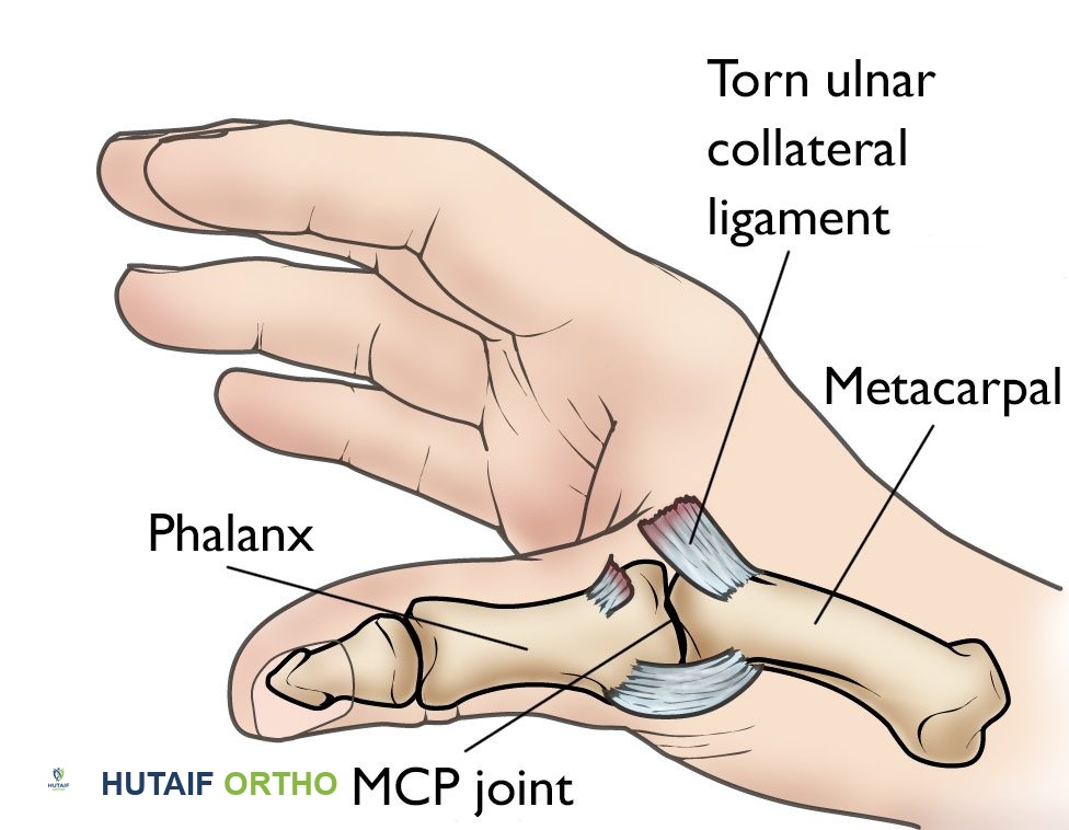 التواء إبهام اليد: دليل شامل للتشخيص والعلاج مع الأستاذ الدكتور محمد هطيف في صنعاء