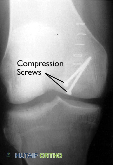 آفة التهاب العظم والغضروف السالخ في الركبة مثبتة بمسامير