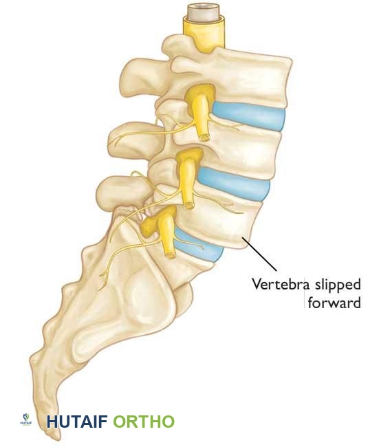 انزلاق فقاري