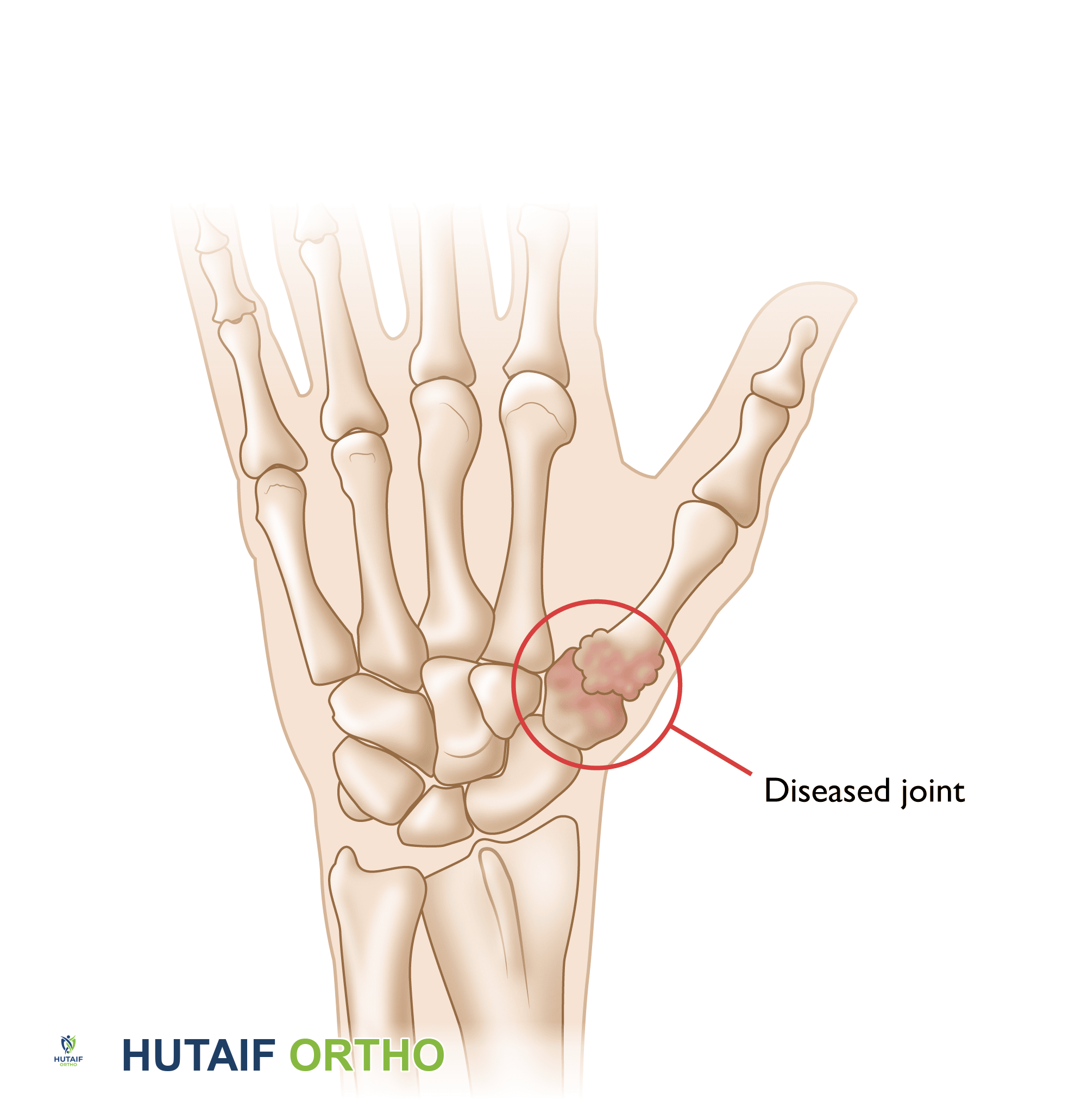 خشونة إبهام اليد: دليل شامل للمرضى من الأستاذ الدكتور محمد هطيف