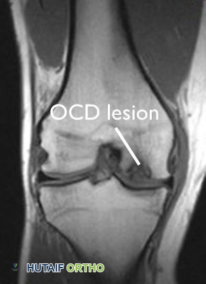 التصوير بالرنين المغناطيسي لآفة التهاب العظم والغضروف السالخ في الركبة