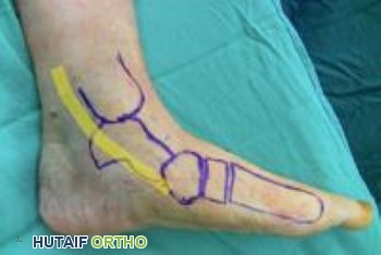 موقع الوتر الظنبوبي الخلفي