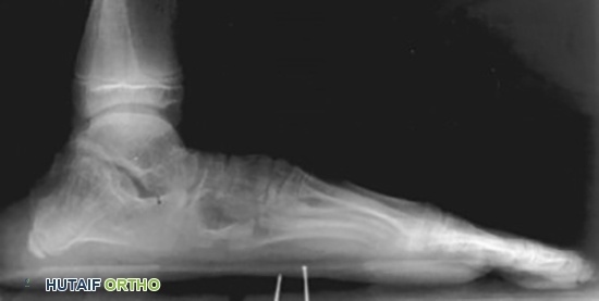 قدم مسطحة لمريض متلازمة مارفان