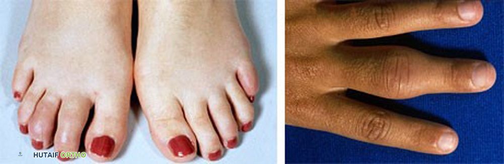 التهاب المفاصل اليفعي: دليل شامل للعائلات والعلاج المتخصص في صنعاء