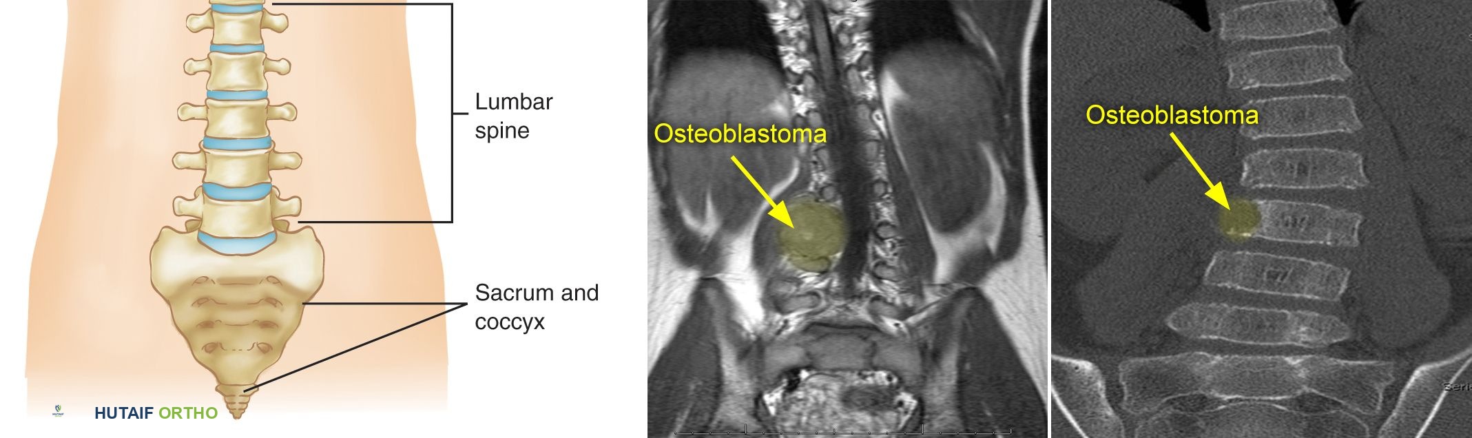 الورم العظمي الوداني (Osteoblastoma): دليل شامل للمرضى مع الأستاذ الدكتور محمد هطيف