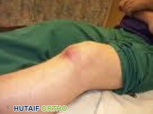 نوبة نقرس مع ركبة حمراء ومتورمة