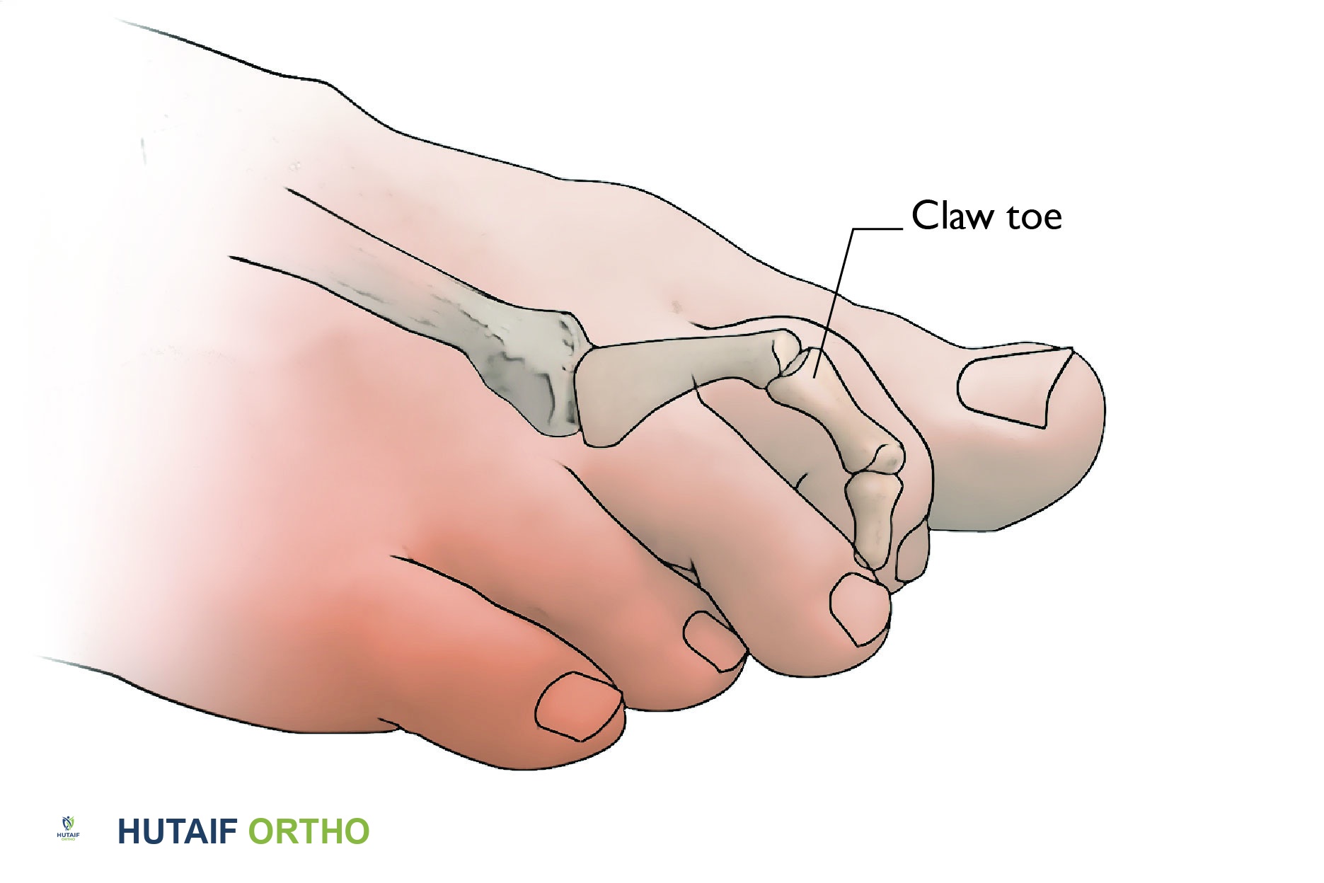 إصبع القدم المخلبي