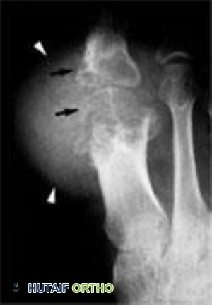 صورة أشعة سينية لنقرس متقدم في إصبع القدم الكبير