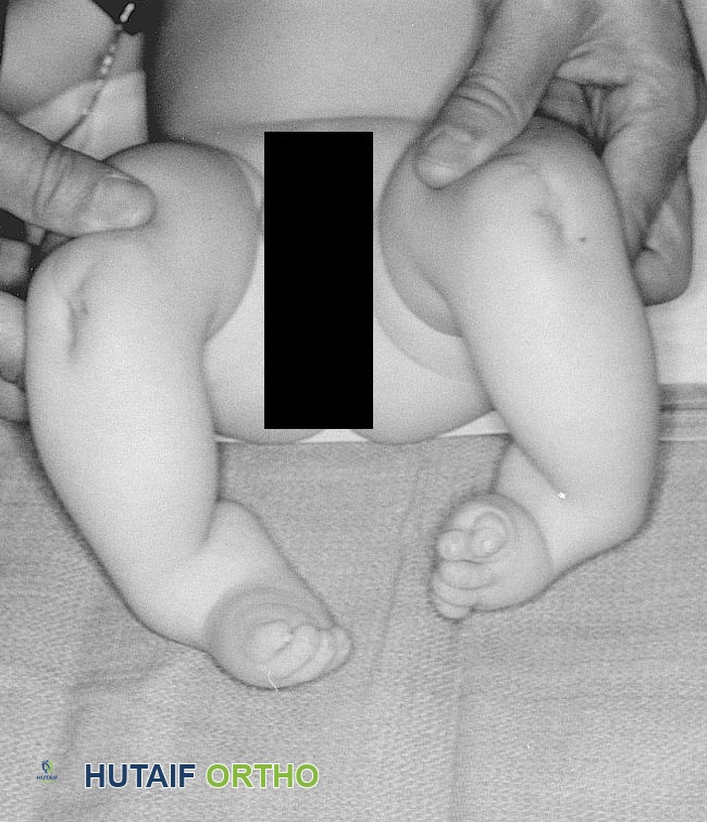 Baby with tibial hemimelia