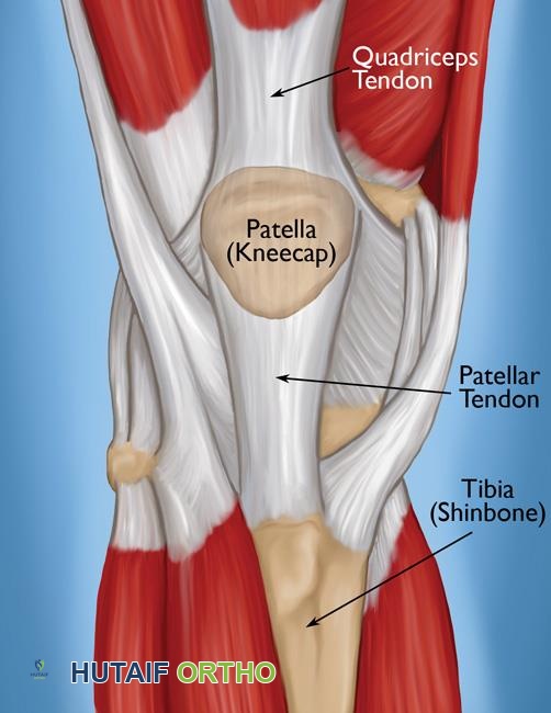 تمزق الوتر الرباعي للركبة الأسباب، الأعراض، التشخيص، والعلاج المتكامل