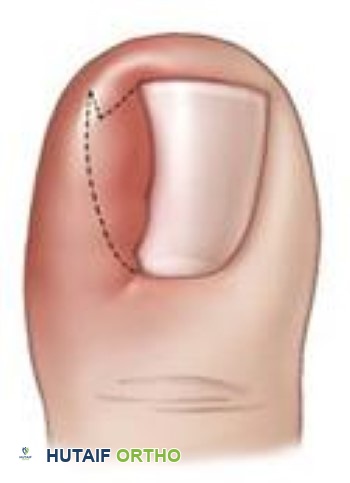 الظفر الغارز في اللحم الأسباب، الأعراض، العلاج والوقاية مع الأستاذ الدكتور محمد هطيف