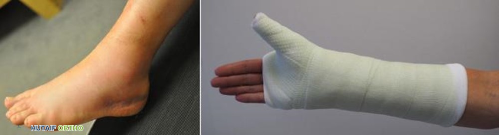 التواء في الكاحل وكسر في الذراع