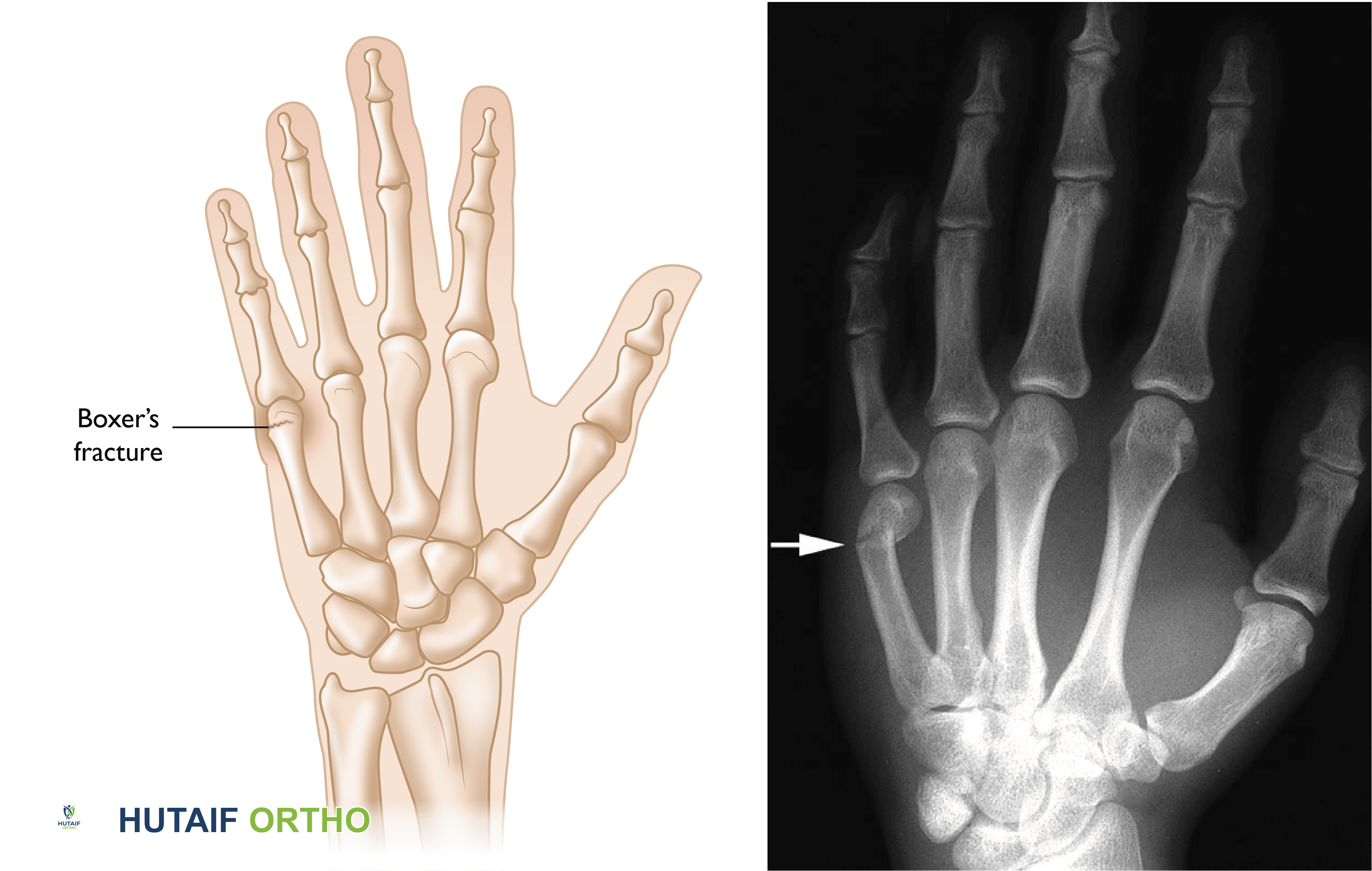 كسر الملاكم