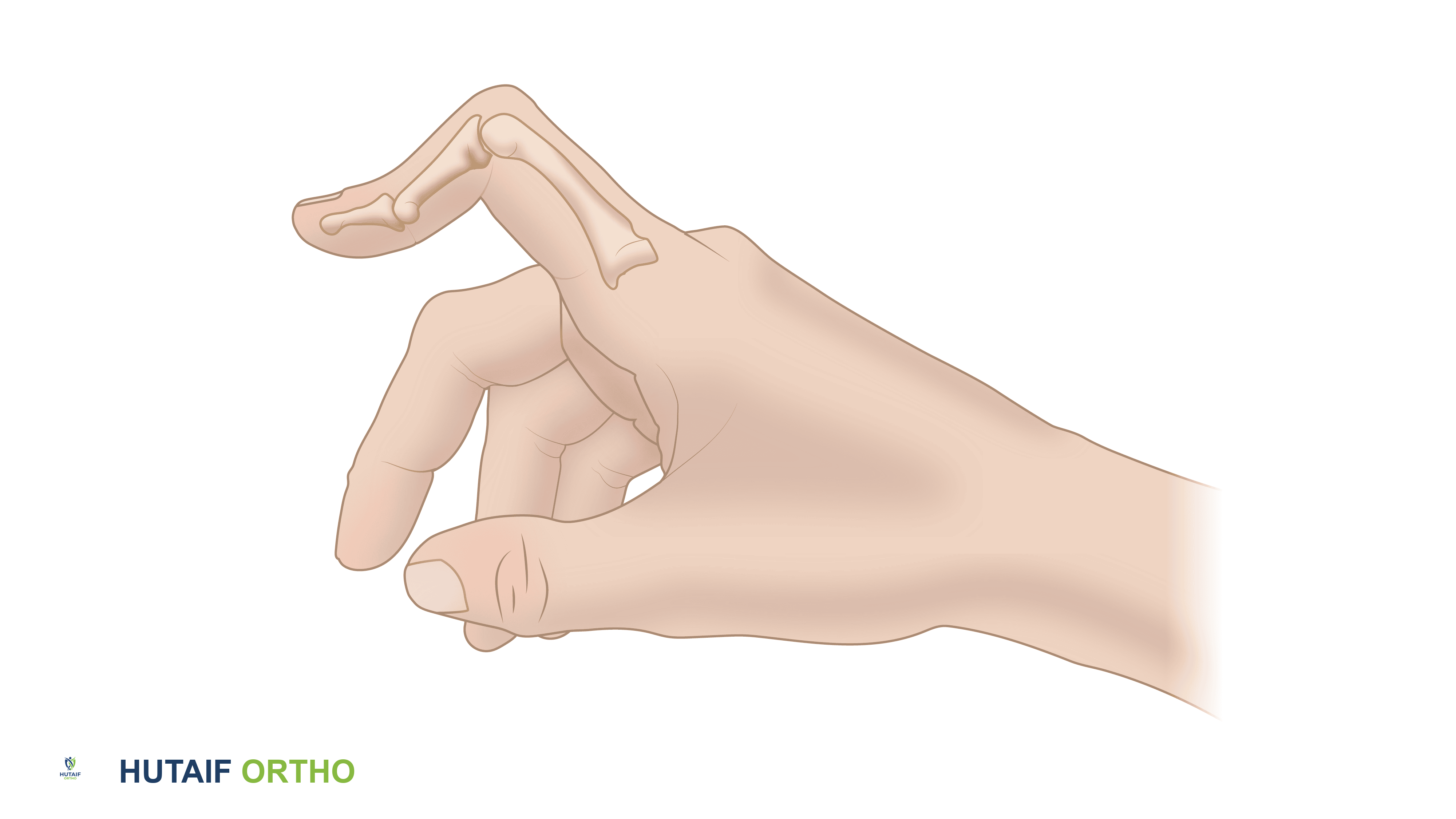 تشوه العروة (Boutonnière Deformity) الأسباب الأعراض والعلاج مع الدكتور محمد هطيف