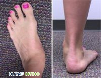 القدم المسطحة