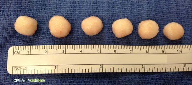 الورم الغضروفي الزليلي: دليل شامل للأسباب، الأعراض، والعلاج الفعال في صنعاء مع الدكتور محمد هطيف