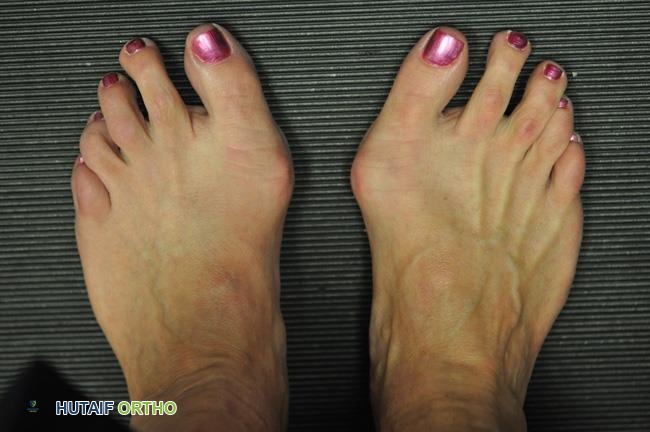 صورة للوكعات في كلتا القدمين