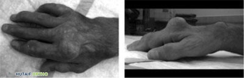 توفى في اليد