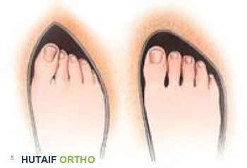 صورة لمقدمة حذاء غير مناسبة ومناسبة